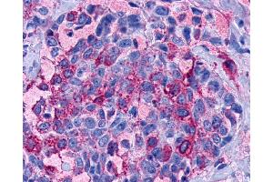 Anti-LPAR3 / LPA3 / EDG7 antibody IHC of human Breast, Carcinoma.