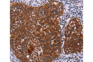 Immunohistochemistry of Human thyroid cancer using USP2 Polyclonal Antibody at dilution of 1:40 (USP2 anticorps)
