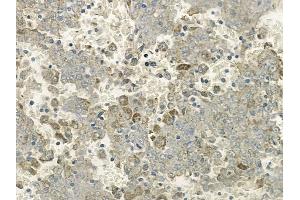 ABIN6263573 and ABIN6272356 at 1/100 staining human melanoma by IHC-P.