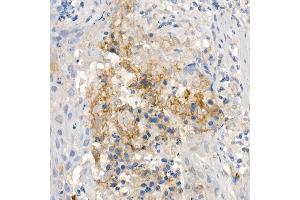 Immunohistochemistry of paraffin-embedded human esophageal cancer using CNTN4 Rabbit mAb (ABIN7266495) at dilution of 1:100 (40x lens). (Contactin 4 anticorps)