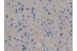 Detection of IGF1 in Human Glioma Tissue using Polyclonal Antibody to Insulin Like Growth Factor 1 (IGF1) (IGF1 anticorps  (AA 49-118))