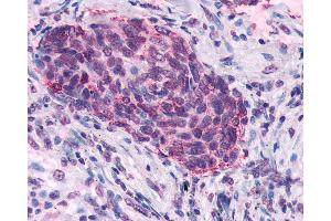 Anti-SSTR5 antibody IHC of human Lung, Small Cell Carcinoma. (SSTR5 anticorps  (C-Term))