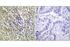 Immunohistochemistry analysis of paraffin-embedded human lung carcinoma tissue, using Aggrecan (Cleaved-Asp369) Antibody.