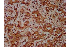IHC image of ABIN7148760 diluted at 1:600 and staining in paraffin-embedded human liver cancer performed on a Leica BondTM system. (Cullin 7 anticorps  (AA 312-450))