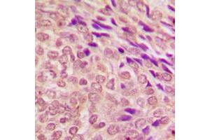 Immunohistochemical analysis of STAT3 staining in human breast cancer formalin fixed paraffin embedded tissue section.