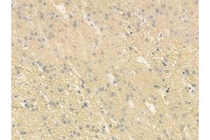 ABIN6260414 and ABIN6279229 at 1/100 staining human glioblastoma by IHC-P.