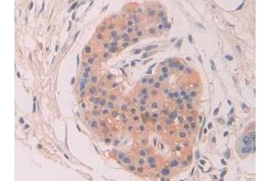 Detection of CHRD in Human Pancreatic cancer Tissue using Polyclonal Antibody to Chordin (CHRD)