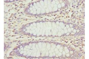 Immunohistochemistry of paraffin-embedded human colon cancer using ABIN7162995 at dilution of 1:100 (PECR anticorps  (AA 24-303))