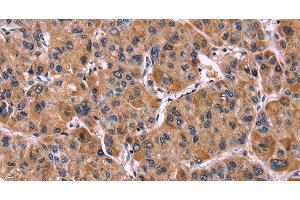 Immunohistochemistry of paraffin-embedded Human liver cancer tissue using LILRB1 Polyclonal Antibody at dilution 1:50