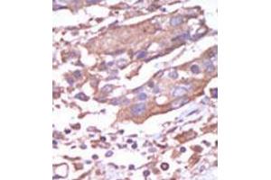 Formalin-fixed and paraffin-embedded human cancer tissue (breast carcinoma) reacted with the primary antibody, which was peroxidase-conjugated to the secondary antibody, followed by AEC staining. (CAMK2A anticorps  (C-Term))