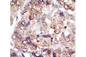 IHC analysis of FFPE human hepatocarcinoma tissue stained with the LYN antibody (LYN anticorps  (AA 32-62))