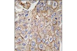 Formalin-fixed and paraffin-embedded human lung carcinoma tissue reacted with CLIC1 antibody, which was peroxidase-conjugated to the secondary antibody, followed by DAB staining. (CLIC1 anticorps)