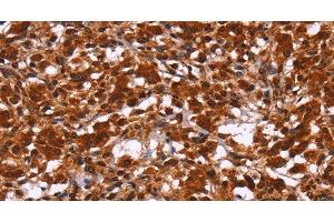 Immunohistochemistry of paraffin-embedded Human thyroid cancer tissue using HIPK1 Polyclonal Antibody at dilution 1:30