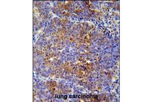 MCAF2 Antibody immunohistochemistry analysis in formalin fixed and paraffin embedded human lung carcinoma followed by peroxidase conjugation of the secondary antibody and DAB staining. (ATF7IP2 anticorps  (AA 318-347))