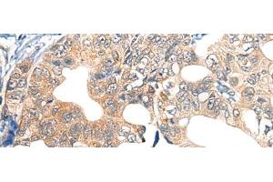 Immunohistochemistry of paraffin-embedded Human gastric cancer tissue using EPHA6 Polyclonal Antibody at dilution of 1:40(x200) (EPH Receptor A6 anticorps)