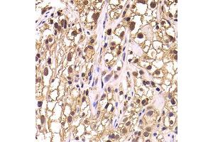 Immunohistochemistry of paraffin-embedded human kidney cancer using TCEB3 antibody (ABIN5975459) at dilution of 1/100 (40x lens). (TCEB3 anticorps)