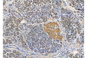 ABIN6261372 and ABIN6279351 at 1/100 staining Human pancreatic cancer and adjacent nomal tissues by IHC-P. (Desmoglein 3 anticorps  (C-Term))