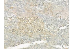 ABIN6260235 and ABIN6276561 at 1/100 staining human lung squamous cell carcinoma by IHC-P.