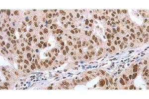 Immunohistochemistry of paraffin-embedded Human ovarian cancer tissue using Oct-6 Polyclonal Antibody at dilution 1:40 (POU3F1 anticorps)
