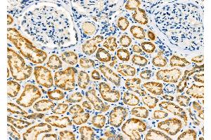 ABIN6264065 and ABIN6273288 at 1/100 staining Human kidney cancer and adjacent normal tissues by IHC-P. (PCCA anticorps  (C-Term))