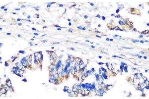 Immunohistochemistry of paraffin-embedded Human colon carcinoma using PBEF / NAMPT Polyclonal Antibody at dilution of 1:100 (40x lens). (NAMPT anticorps)