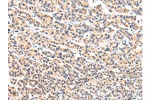 The image on the left is immunohistochemistry of paraffin-embedded Human liver cancer tissue using ABIN7131592(VPS54 Antibody) at dilution 1/20, on the right is treated with fusion protein. (VPS54 anticorps)