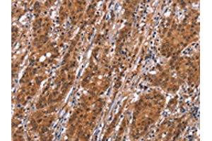 The image on the left is immunohistochemistry of paraffin-embedded Human gastric cancer tissue using ABIN7192526(SLC8A2 Antibody) at dilution 1/15, on the right is treated with synthetic peptide. (SLC8A2 anticorps)