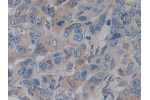 Detection of CYP21A2 in Human Breast cancer Tissue using Polyclonal Antibody to Cytochrome P450 Family 21 Subfamily A Member 2 (CYP21A2)