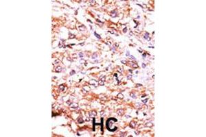 Formalin-fixed and paraffin-embedded human hepatocellular carcinoma tissue reacted with GUCY1A2 polyclonal antibody  , which was peroxidase-conjugated to the secondary antibody, followed by AEC staining. (GUCY1A2 anticorps  (N-Term))