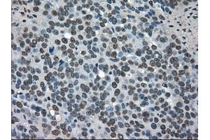 Immunohistochemical staining of paraffin-embedded Adenocarcinoma of breast tissue using anti-SOD1 mouse monoclonal antibody. (SOD1 anticorps)