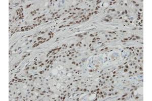 IHC-P Image Immunohistochemical analysis of paraffin-embedded oral CA cell lines Ca922 xenograft, using BCL7A, antibody at 1:100 dilution. (BCL7A anticorps  (C-Term))
