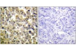 Immunohistochemistry analysis of paraffin-embedded human breast carcinoma, using MSK1 (Phospho-Ser360) Antibody. (MSK1 anticorps  (pSer360))