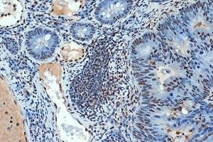 Immunohistochemistry of paraffin-embedded human colon carcinoma using SUMO4 Rabbit mAb (ABIN7270372) at dilution of 1:100 (40x lens).