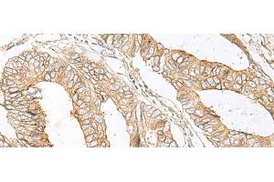 Immunohistochemistry of paraffin-embedded Human colorectal cancer tissue using SLC5A1 Polyclonal Antibody at dilution of 1:80(x200) (SLC5A1 anticorps)