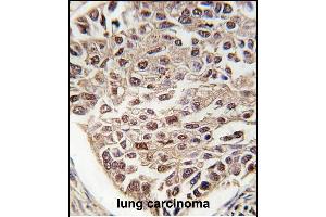 Formalin-fixed and paraffin-embedded human lung carcinoma tissue reacted with SFRS2 antibody (N-term), which was peroxidase-conjugated to the secondary antibody, followed by DAB staining. (SRSF2 anticorps  (N-Term))