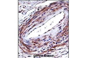 P2RX5 Antibody (C-term) ((ABIN657980 and ABIN2846926))immunohistochemistry analysis in formalin fixed and paraffin embedded human cervix tissue followed by peroxidase conjugation of the secondary antibody and DAB staining.