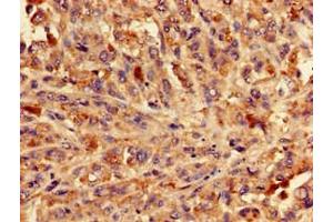 Immunohistochemistry of paraffin-embedded human melanoma using ABIN7154332 at dilution of 1:100