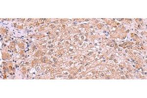 Immunohistochemistry of paraffin-embedded Human liver cancer tissue using RIC3 Polyclonal Antibody at dilution of 1:90(x200) (RIC3 anticorps)