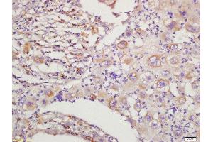Formalin-fixed and paraffin embedded human lung cancer labeled with Rabbit Anti-RAC1+RAC2 Polyclonal Antibody, Unconjugated  at 1:200 followed by conjugation to the secondary antibody and DAB staining (RAC1 anticorps  (AA 101-192))