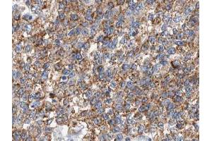 ABIN6266637 at 1/100 staining human lung carcinoma tissue sections by IHC-P. (CSTB anticorps  (C-Term))