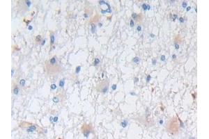Detection of NES in Human Glioma Tissue using Polyclonal Antibody to Nestin (NES)