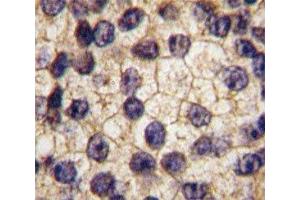 IHC analysis of FFPE human prostate carcinoma tissue stained with PDGFR alpha antibody (PDGFRA anticorps  (AA 740-769))