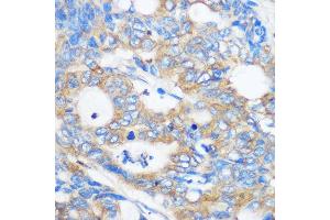 Immunohistochemistry of paraffin-embedded Human colon carcinoma using PEBP4 Rabbit pAb (ABIN7269280) at dilution of 1:100 (40x lens). (PEBP4 anticorps)