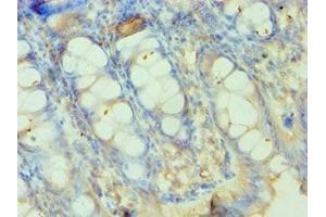 Immunohistochemistry of paraffin-embedded human colon tissue using ABIN7155524 at dilution of 1:100 (SMYD3 anticorps  (AA 199-428))