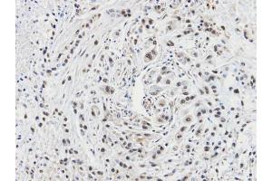 IHC-P Image Immunohistochemical analysis of paraffin-embedded A549 xenograft, using CacyBP, antibody at 1:100 dilution. (CACYBP anticorps  (C-Term))