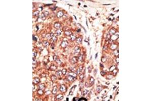 Formalin-fixed and paraffin-embedded human cancer tissue reacted with the primary antibody, which was peroxidase-conjugated to the secondary antibody, followed by AEC staining. (Septin 9 anticorps  (C-Term))