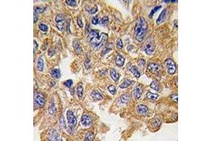 IHC analysis of FFPE human lung carcinoma tissue stained with AKT2 antibody