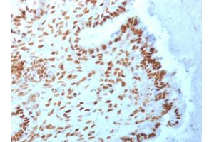 Formalin-fixed, paraffin-embedded human Endometrial Carcinoma stained with TLE1 Mouse Monoclonal Antibody (TLE1/2062). (TLE1 anticorps  (AA 175-338))