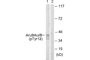 Immunohistochemistry analysis of paraffin-embedded human liver carcinoma tissue using AurB (Phospho-Tyr12) antibody. (Aurora Kinase B anticorps  (pTyr12))