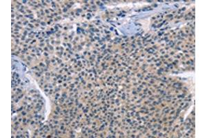 The image on the left is immunohistochemistry of paraffin-embedded Human liver cancer tissue using (LRRK2 Antibody) at dilution 1/30, on the right is treated with fusion protein. (LRRK2 anticorps)